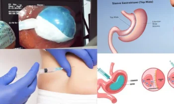 Gastrik Sleeve Ameliyatı Kalıcı Bir Çözüm Müdür?